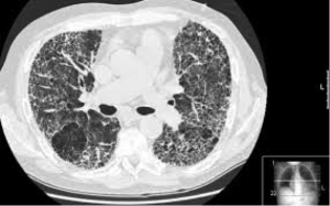 CT Scan Pulmonary Fibrosis